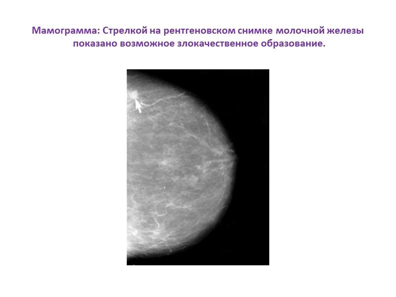 Мамограмма: Стрелкой на рентгеновском снимке молочной железы   показано возможное злокачественное образование.